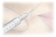 Egypt Cairo plastic cosmetic surgery scars wrinkles botox fillers mesotherapy