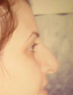 Cosmetic Egypt Surgery Rhinoplasty tip drooping nose job Plastic Hump
