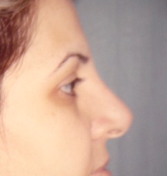 Plastic Surgery Egypt Dr. Adel Wilson liposuction tip nose job bariatric 
