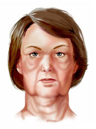 Plastic Surgery, Cosmetic Surgery, Egypt, face lift, neck lift, platyzmaplasty