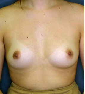 Cosmetic Surgery Egypt, Fat Injection, Fat Grafting, Breast Augmentation, Breast