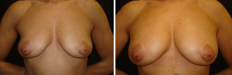 Aesthetic Surgery Egypt, Fat Injection, Fat Grafting, Breast Augmentation, Breas
