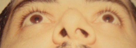 Open rhinoplasty tip Egypt deviated septum nose job abroad rhinoplasty touris