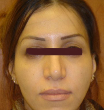 Plastic Surgery Egypt face lift nose restylane eyelid bariatric cosmetic cairo