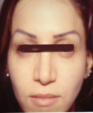Cosmetic Surgery Egypt fat injection filler restylane botox laser face lift