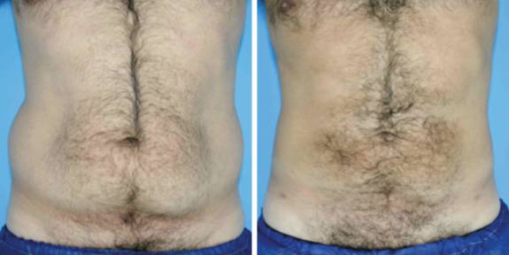 Liposuction,Laser Liposuction,Smart Liposuction,Egypt Cosmetic Surgery,Plastic