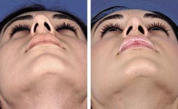Nose job Egypt,Deviated Nose,Cosmetic Surgery Egypt,Deviated,Dorsum,Rhinoplasty