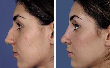 Cosmetic Surgery Egypt,Plastic Surgery Egypt,Nose Job,Dorsal Hump,Nose tip,
