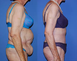 Cosmetic Surgery Egypt, Bariatric surgery, Weight Loss, Tummy Tuck, Abdominoplas