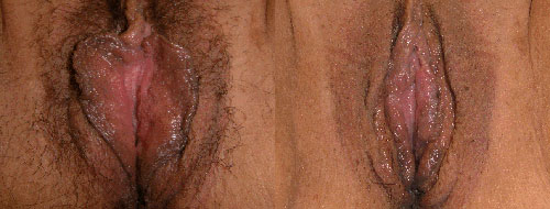 Plastic Surgery Egypt,Cosmetic Surgery,Vaginoplasty,Labiaplasty,hymen,G-spot