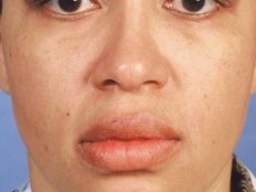 Lip surgery, Lip reduction Surgery, Best Cosmetic Surgery, Lip Fillers Plastic