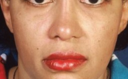 Lip surgery, Lip reduction Surgery, Best Cosmetic Surgery, Lip Fillers Cosmetic