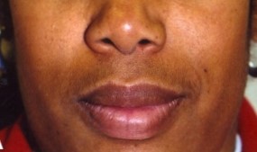 Lip surgery, Lip reduction Surgery, Best Plastic Surgery, Lip Fillers Plastic