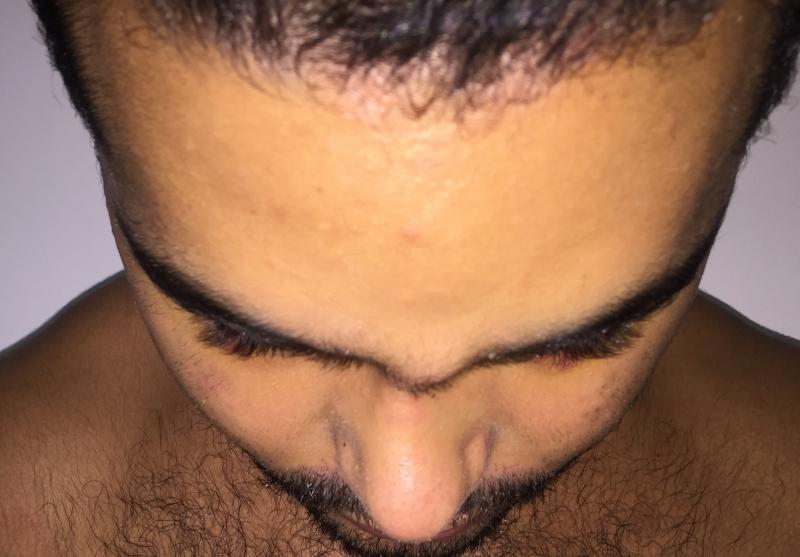 Cheek Implants, Malar Implants, Best Aesthetic Surgery Egypt, Face Eyelid Lift
