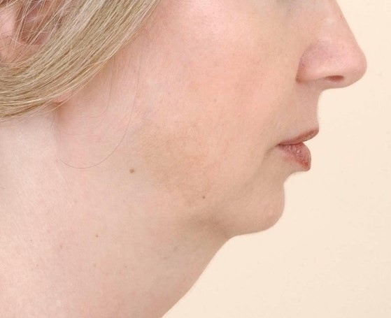Neck Lift, Neck Laxity, Neck wrinkles, 4D Laser Lipo, Neck Vaser Liposuction