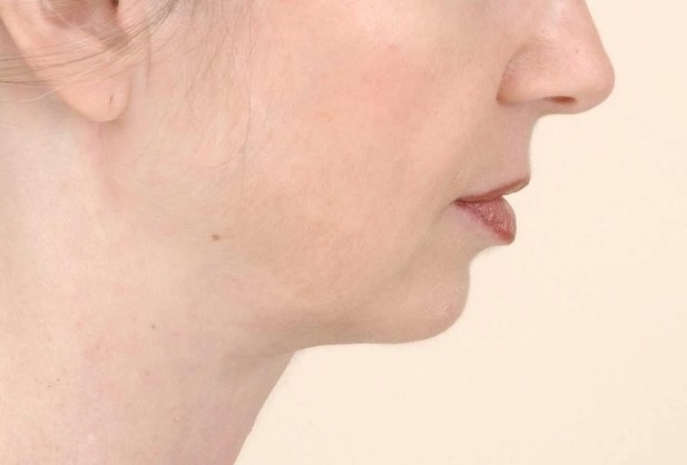 Neck Lift, Neck Laxity, Neck wrinkles, 4D Vaser Lipo, Neck Vaser Liposuction