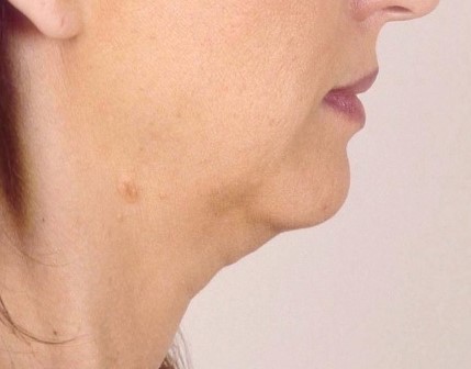 Neck Lift, Neck High Definition 4D Vaser Liposuction, Best Cosmetic Surgery 