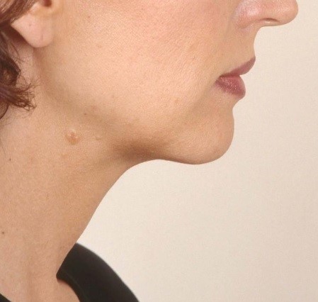 Neck Lift, Neck High Definition 4D Vaser Liposuction, Best Aesthetic Surgery