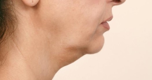 Neck Lift, Jaw lines, Neck wrinkles, 4D Vaser Lipo, Neck Vaser Liposuction