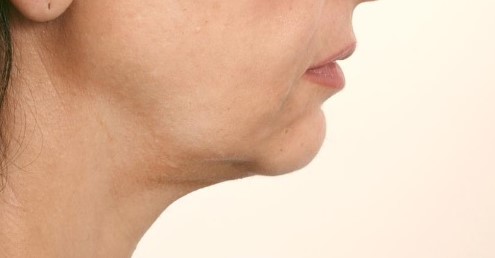 Neck Lift, Neck Laxity, Neck Definition, 4D Vaser Lipo, Neck Vaser Liposuction