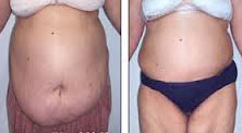 Plastic surgery in Egypt, Abdominoplasty, Tummy Tuck, Sleeve Gastrectomy