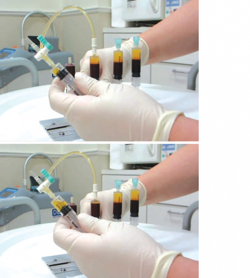 Platelet Rich Plasma, PRP, Aesthetic Surgery, Fat Grafting, Hair Transplantation