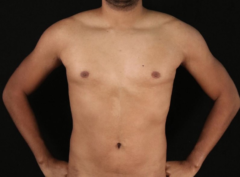 High Definition Liposculpture, Vaser Liposculpture, 4D Liposculpture, 6-pack