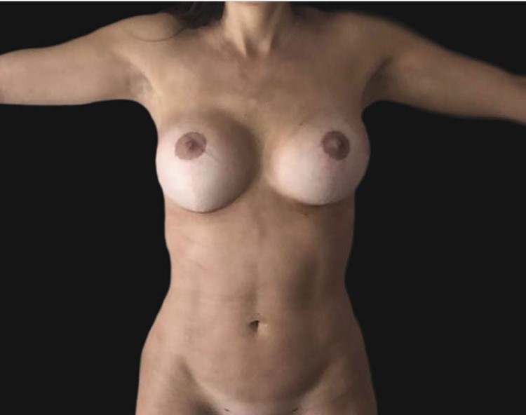 Tummy 4 D liposuction, Flank High Definition Liposuction, bra line Laser Lipo